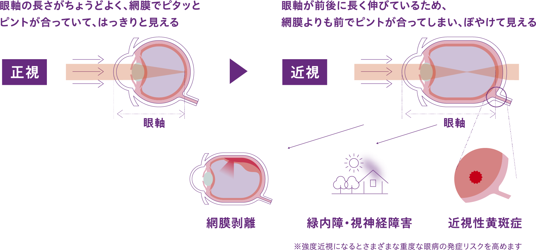 近視のリスクと進行